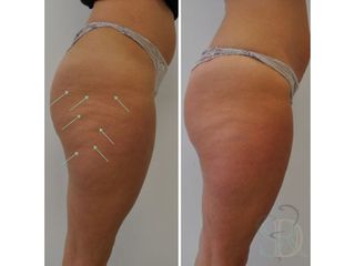 Cellulite prima e dopo