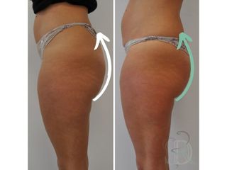 Cellulite prima e dopo