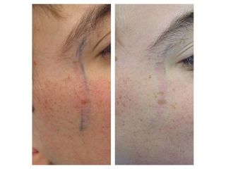 Cicatrice prima e dopo