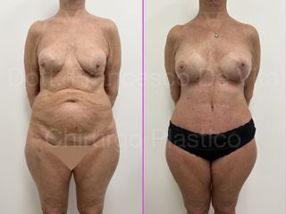 Liposcultura - Dott. Francesco De Vita