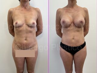 Liposcultura - Dott. Francesco De Vita