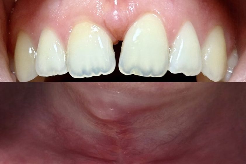 Laser dentale prima e dopo - 870729