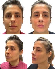 Dott.ssa Sara Carinci Full face viso