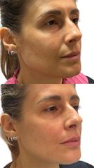 Dott.ssa Sara Carinci Full face viso