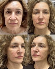 Dott.ssa Sara Carinci Full face viso