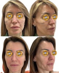 Dott.ssa Sara Carinci Full face viso