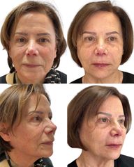 Dott.ssa Sara Carinci Full face viso