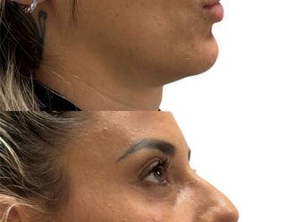 Filler prima e dopo - 874242