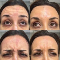 Dott.ssa Sara Carinci Botox