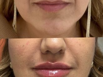 Filler labbra prima e dopo - 874301