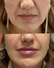 Dott.ssa Sara Carinci Filler labbra