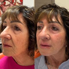 Dott.ssa Sara Carinci Full face viso