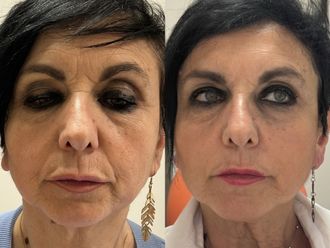 Acido ialuronico prima e dopo - 874540