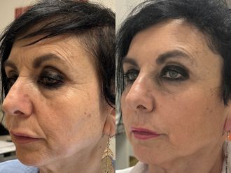 Acido ialuronico prima e dopo - 874541