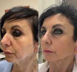 Dott.ssa Sara Carinci Full face viso