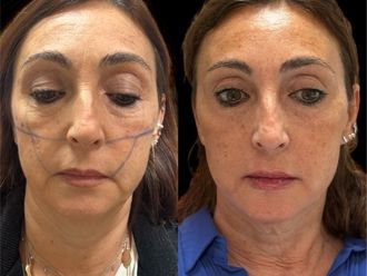 Acido ialuronico prima e dopo - 874892