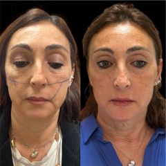 Dott.ssa Sara Carinci Full face viso