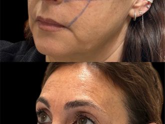Acido ialuronico prima e dopo - 874893