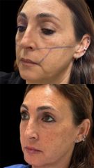Dott.ssa Sara Carinci Full face viso
