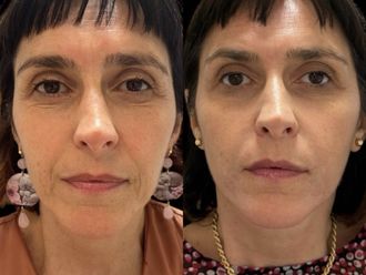 Acido ialuronico prima e dopo - 874895
