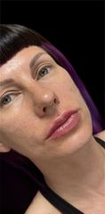 Dott.ssa Sara Carinci Filler labbra