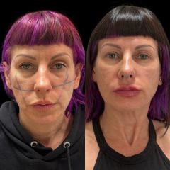 Dott.ssa Sara Carinci Full face viso