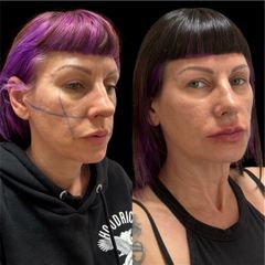 Dott.ssa Sara Carinci Full face viso