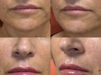 Filler labbra prima e dopo - 875263