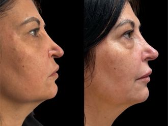 Filler prima e dopo - 875283