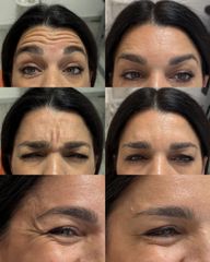 Dott.ssa Sara Carinci Botox