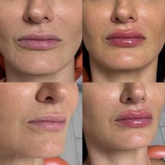 Dott.ssa Sara Carinci Filler labbra prima e dopo