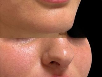 Filler labbra prima e dopo - 875499
