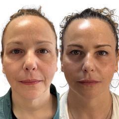 Dott.ssa Sara Carinci Full face viso