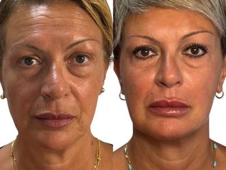 Acido ialuronico prima e dopo - 875720