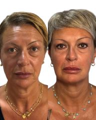 Full face botox - Dott.ssa Sara Carinci