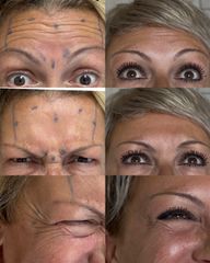 Botox - Dott.ssa Sara Carinci