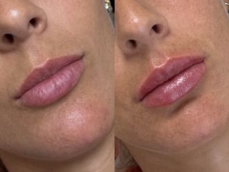 Filler labbra prima e dopo - 876444