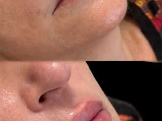 Filler labbra prima e dopo - 876454