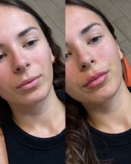 Dott.ssa Sara Carinci Filler labbra