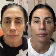 Dott.ssa Sara Carinci Full face viso