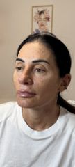 Dott.ssa Sara Carinci Full face viso