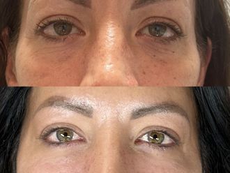 Eliminare occhiaie prima e dopo - 876671