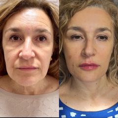 Dott.ssa Sara Carinci Full face viso