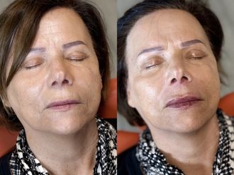 Filler labbra prima e dopo - 876922