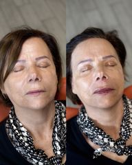 Dott.ssa Sara Carinci Filler labbra
