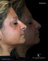 Dott.ssa Sara Carinci Rinofiller