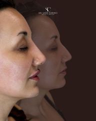 Dott.ssa Sara Carinci Filler Labbra