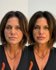 Dott.ssa Sara Carinci Filler labbra