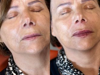 Filler labbra prima e dopo - 877466