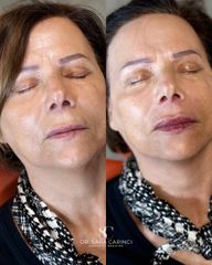 Dott.ssa Sara Carinci Filler labbra